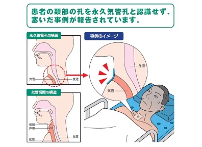 首の「永久気管孔」、フィルム材貼付は厳禁のサムネイル画像