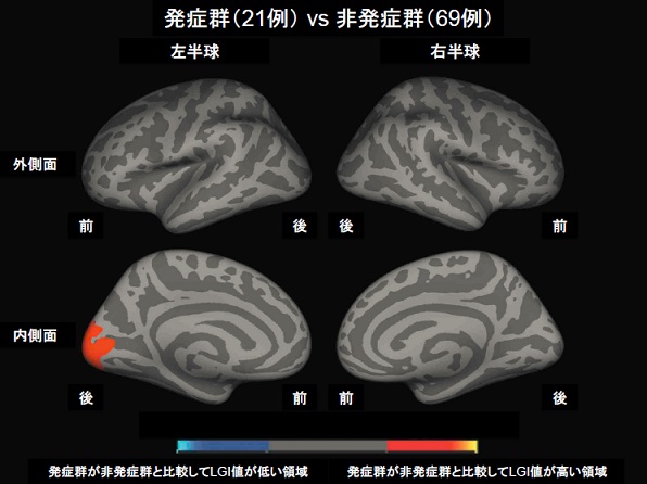 統合失調症と大脳皮質表面入り組みに関係のサムネイル画像