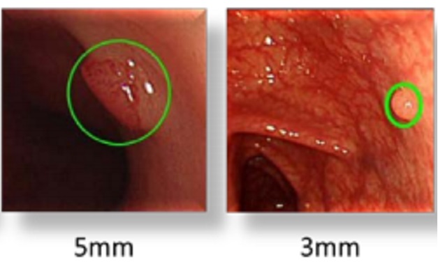 AI活用した内視鏡検査で大腸ポリープ発見のサムネイル画像