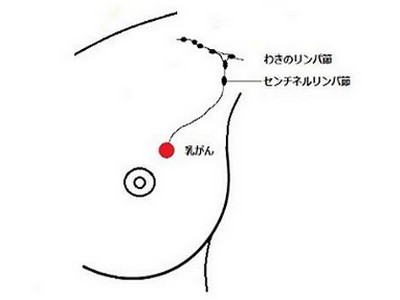 乳がんリンパ節転移の有無を画像診断、手術回避へのサムネイル画像