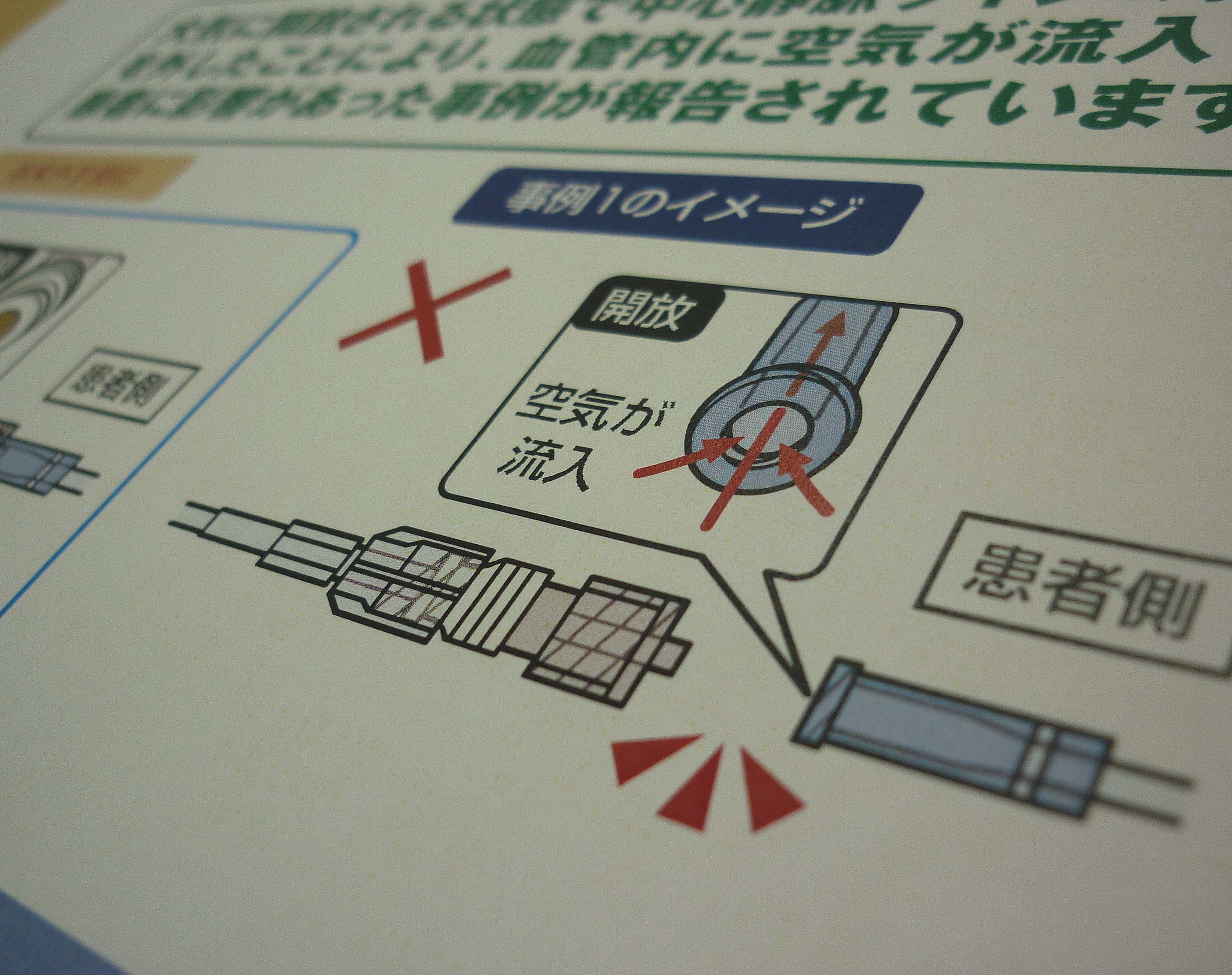 中心静脈ライン、不適切な接続外しで空気塞栓のサムネイル画像