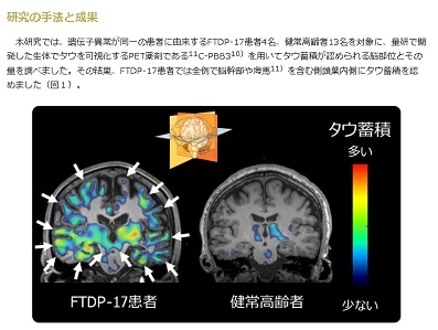 遺伝性認知症で起こる脳内異常を解明のサムネイル画像