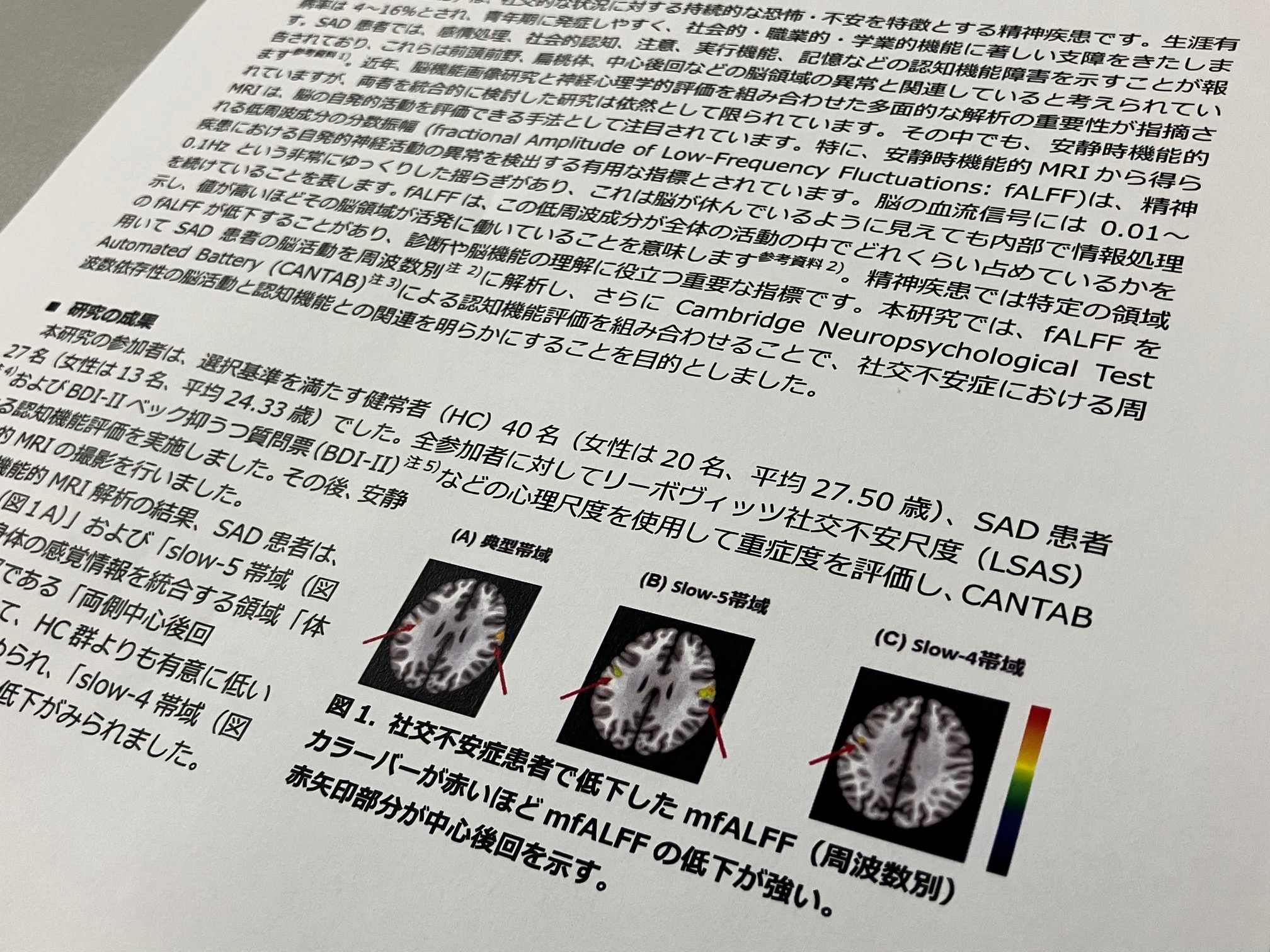 社交不安症患者、感覚処理領域の脳活動が低下のサムネイル画像