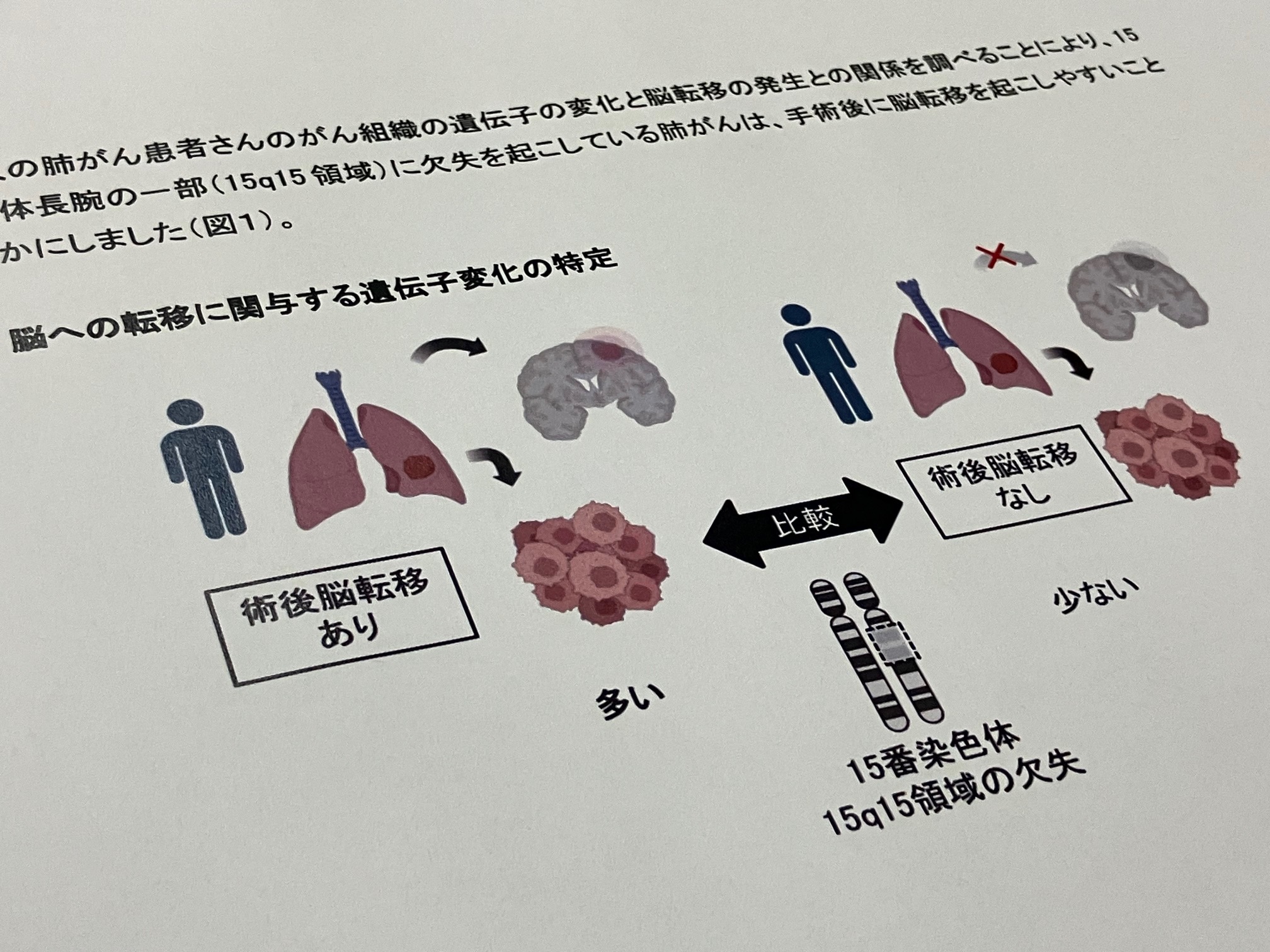 肺がん、脳転移に関与する遺伝子変化特定のサムネイル画像