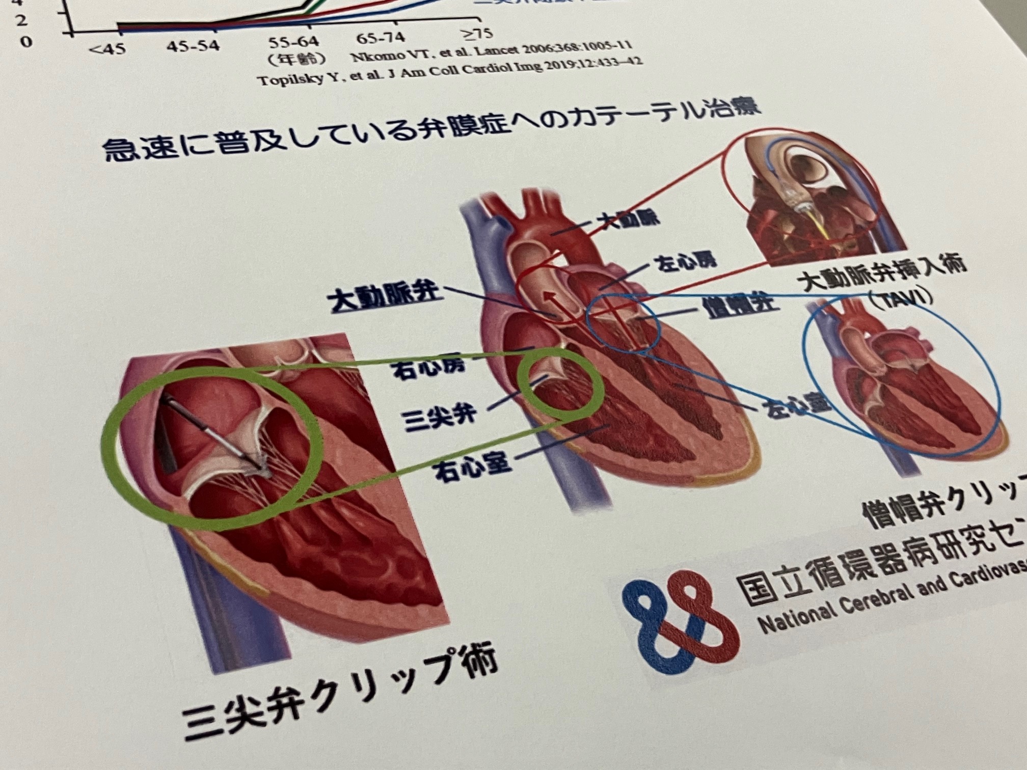経皮的三尖弁クリップ留置術、西日本で初めて実施のサムネイル画像