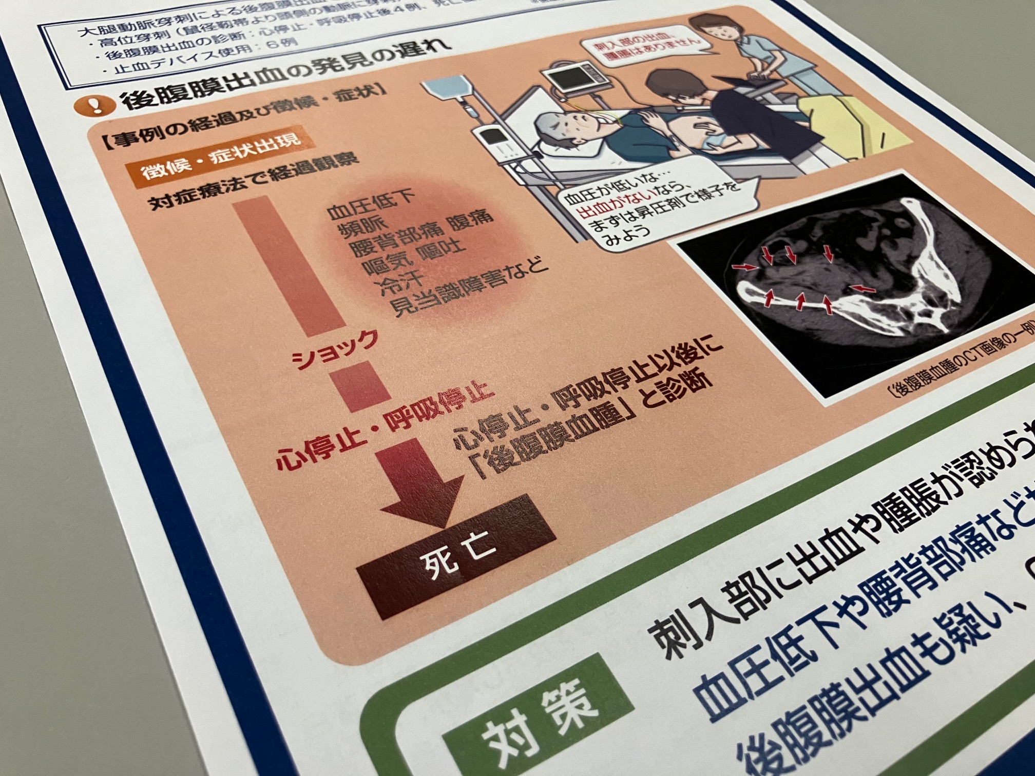 大腿動脈穿刺に伴う後腹膜出血で警鐘のサムネイル画像